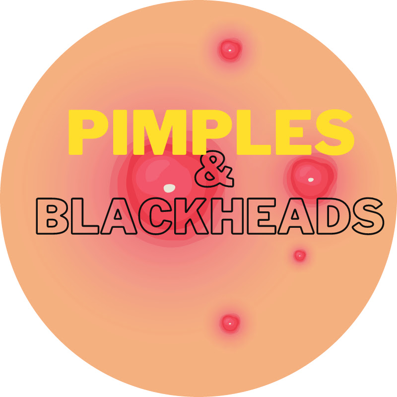 Pimples and Blackheads