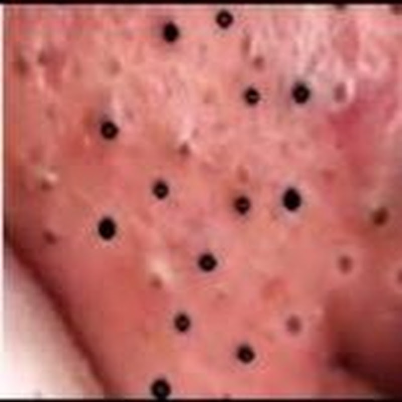 I Pimple Spa