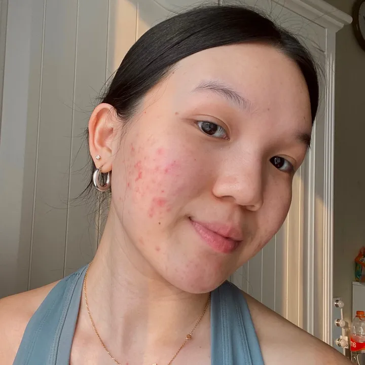 san | acne & textured skin