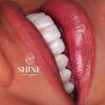 PORCELAIN VENEERS COLOMBIA