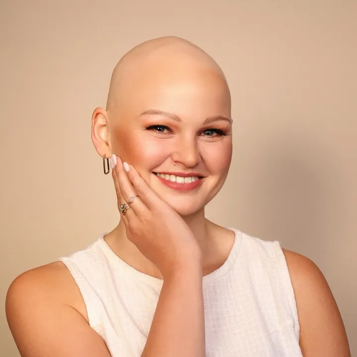 Leven met alopecia l Amber