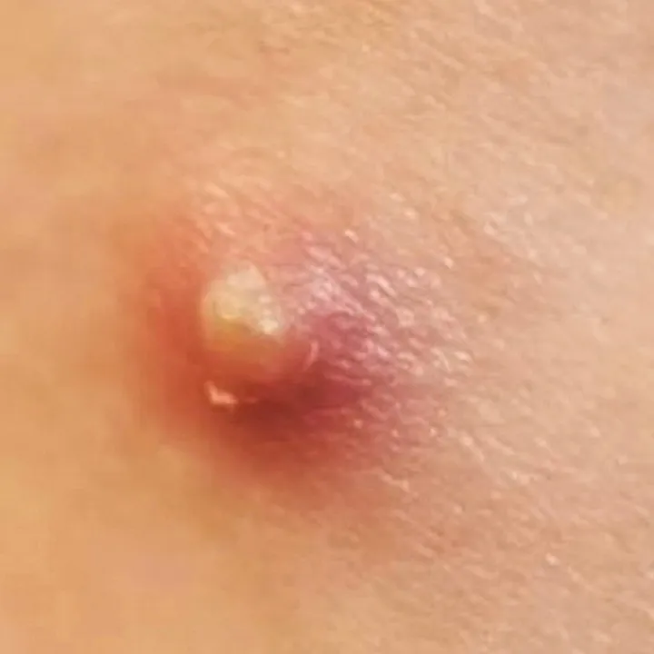 brufoli_pimple