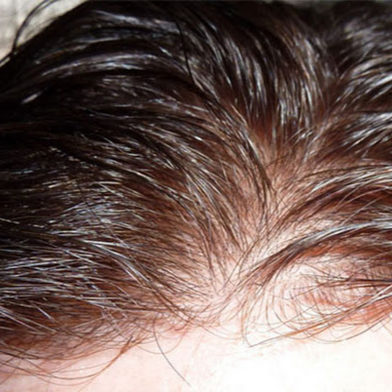 تركيب شعر طبيعي رجالي و حريمي hair system