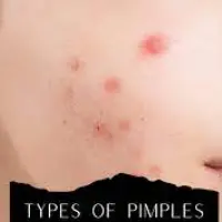 Doctors Pimples